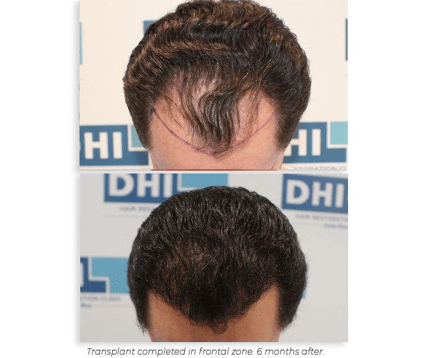 Hair Transplant Dhi Sri Lanka